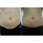 фото Косметолог / Чистка лица/ Пилинг/Мезопилинг