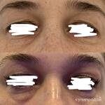 фото Лазерная шлифовка верхнего и нижнего века на DEKA CO2 (Италия)